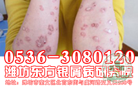 济南牛皮癣医院医生介绍：多吃水果有利于健康
