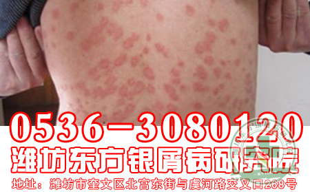 山东牛皮癣医院医生教您如何护理皮肤?