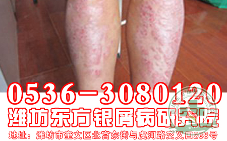 济宁牛皮癣医院医生解析为什么牛皮癣久治不愈?