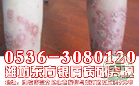 预防牛皮癣，济南牛皮癣医院医生办法多