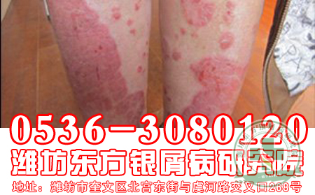 牛皮癣患者关注：网上骗局要小心