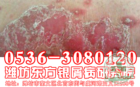 脓疱型牛皮癣护理注意事项?