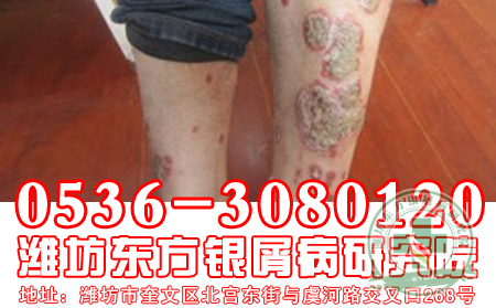 牛皮癣患者居室环境选择