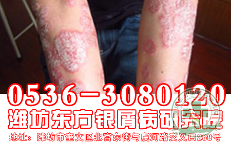 脚部牛皮癣患者如何泡脚?