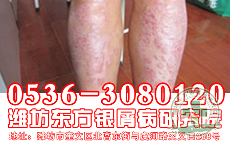 牛皮癣可以用膏药吗