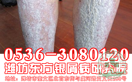 牛皮癣非药物治疗