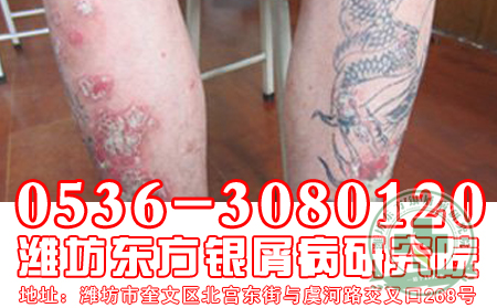 牛皮癣发病与天气有关