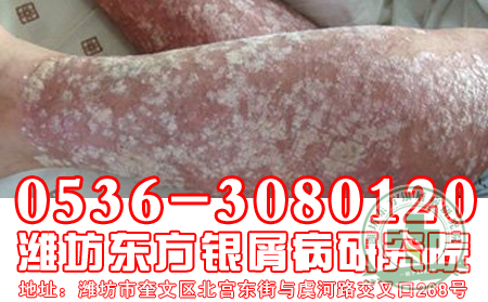 牛皮癣患者如何改变局部皮损?
