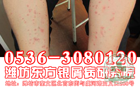 女性牛皮癣为什么反复复发?