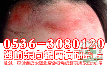 牛皮癣患者改善肌肤敷脸秘诀