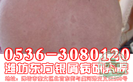 夏季警惕蚊虫叮咬诱发银屑病