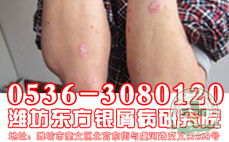 银屑病患者夏季可以游泳吗？