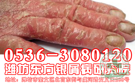 牛皮癣患者适当喝红酒有什么可以处?