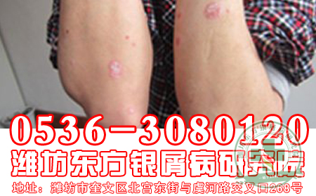 牛皮癣的预防护理措施有哪些?