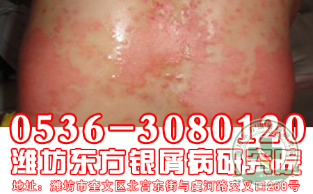 浅谈压力跟牛皮癣的关系