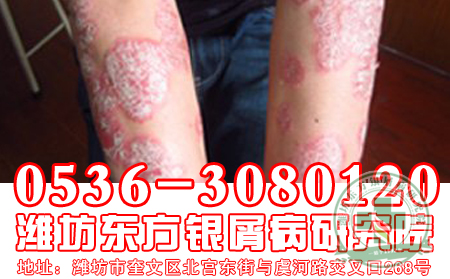 更年期撞上牛皮癣， 三招可缓解