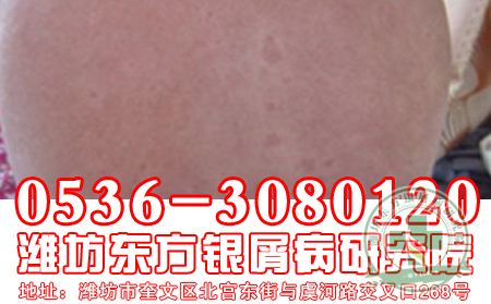 牛皮癣患者能吃海带吗?