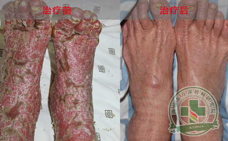 老年银屑病患者如何做好护理呢？