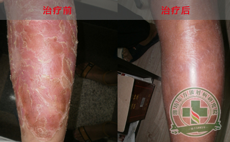 银屑病患者心理保健措施有哪些？