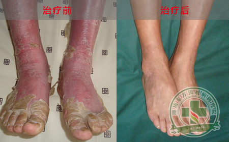 银屑病能不能吃油炸食品？