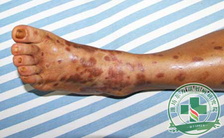 银屑病治疗