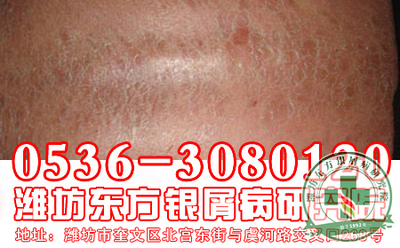济南银屑病患者多关注酸奶饮用