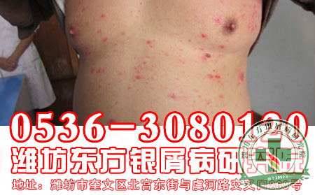 济南银屑病医院—银屑病罕见类型认识