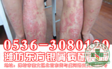 济南银屑病医院—银屑病疾病减缓诀窍