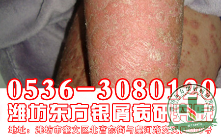银屑病恢复与遗传认识