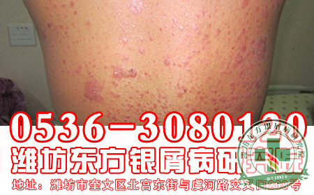 银屑病病患情况认识