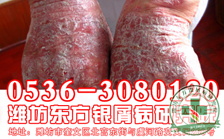 山东银屑病医院—银屑病分类认识
