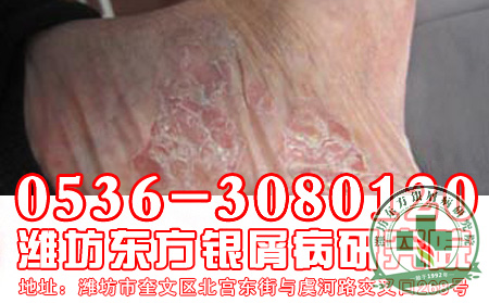 济南银屑病介绍银屑病病变因素