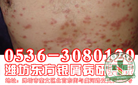 银屑病的患病原因是什么？