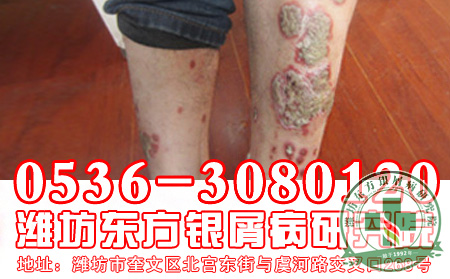 哪些原因会导致银屑病发病？