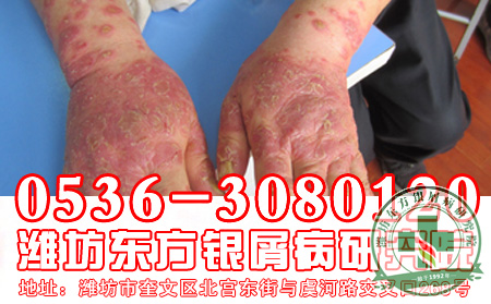 怎样做有助于减少银屑病加重？