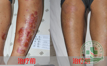 牛皮癣易遗传哪类体质？