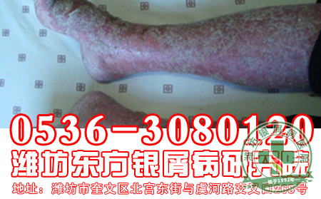 怎样做有助于防止银屑病复发？
