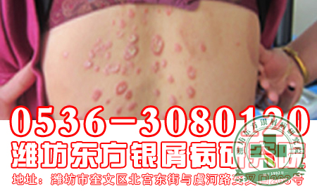 银屑病的产生是怎么回事？