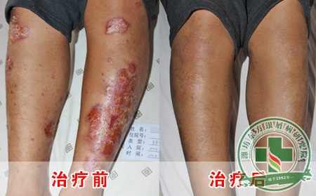 银屑病身上脱屑怎么办