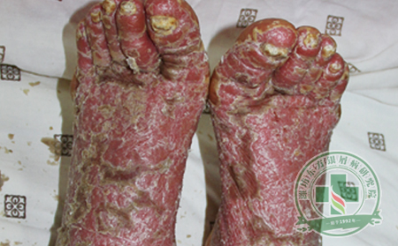 银屑病传染吗?
