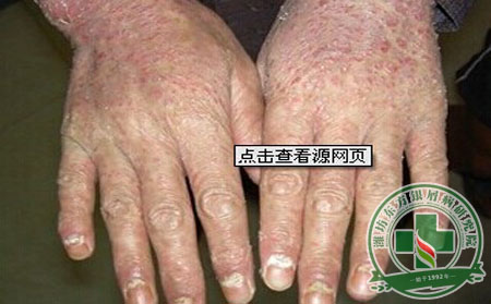 得了牛皮癣健康保健很重要