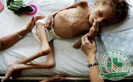 牛皮癣患者营养不良会出现什么后果呢?