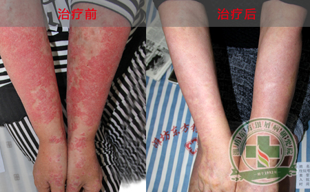 银屑病患者治疗的误区