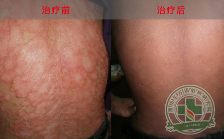 银屑病要怎么治疗