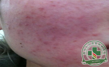 面部牛皮癣有哪些饮食禁忌?