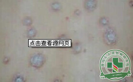 医生解析点滴状牛皮癣的发病特点