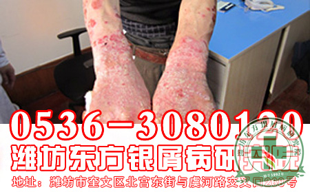 关节型银屑病怎样健身可以呢？