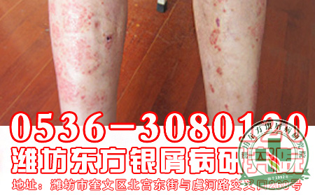 跑步对银屑病患者都适合吗？