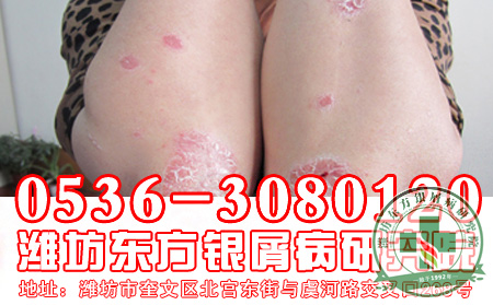 银屑病患者不宜下厨房