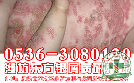 银屑病的危害有哪些？